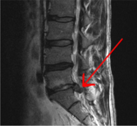 Disc Herniation