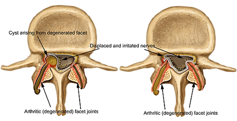 Facet Arthritis