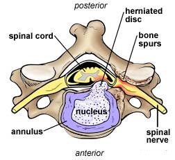 Herniated Disc in Neck