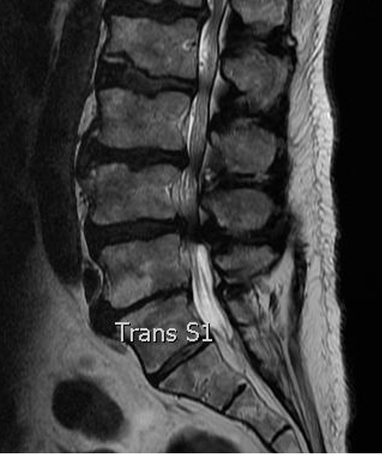 Stenosis