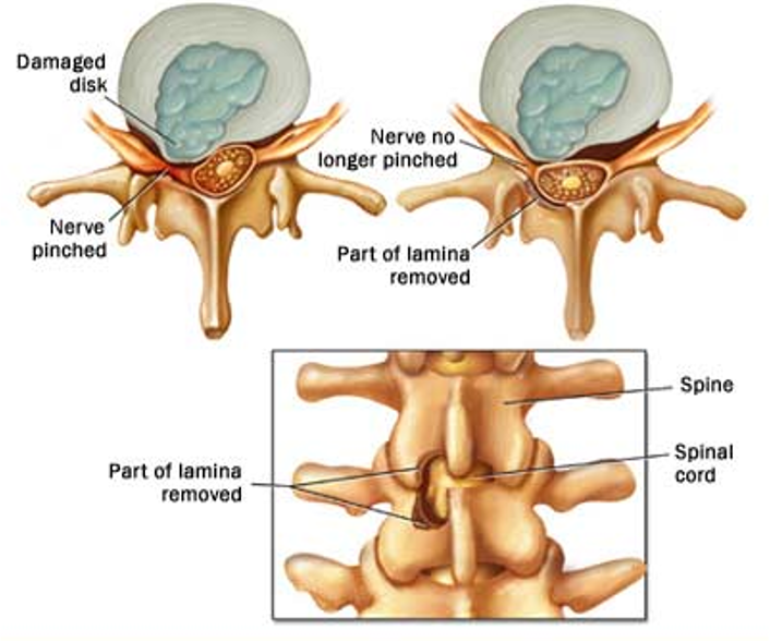 Microdiscectomy