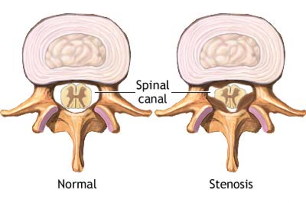 Spinal Stenosis