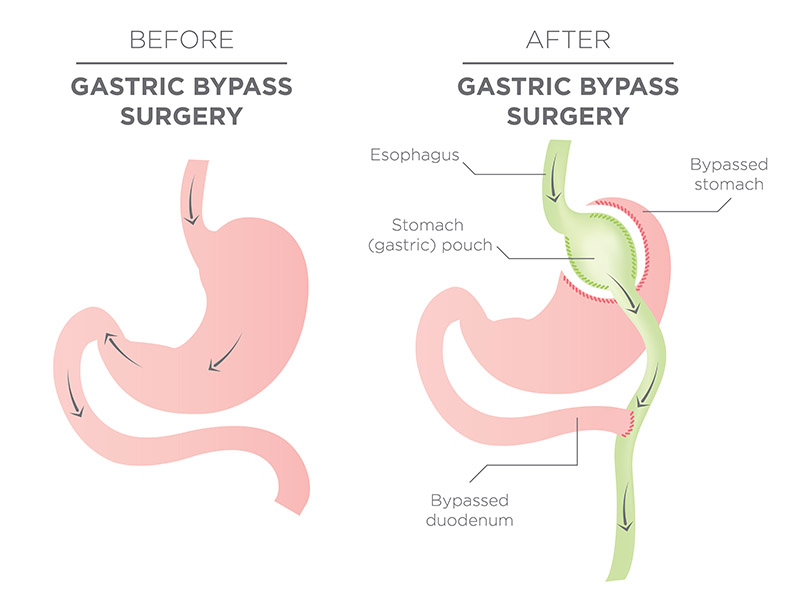 gastric bypass surgery diagram