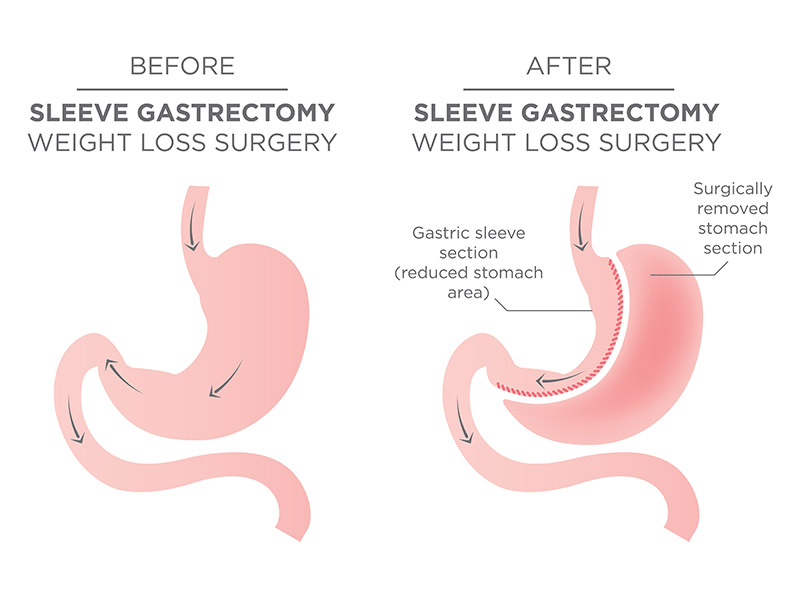 Laparoscopic Sleeve Gastrectomy Diagram